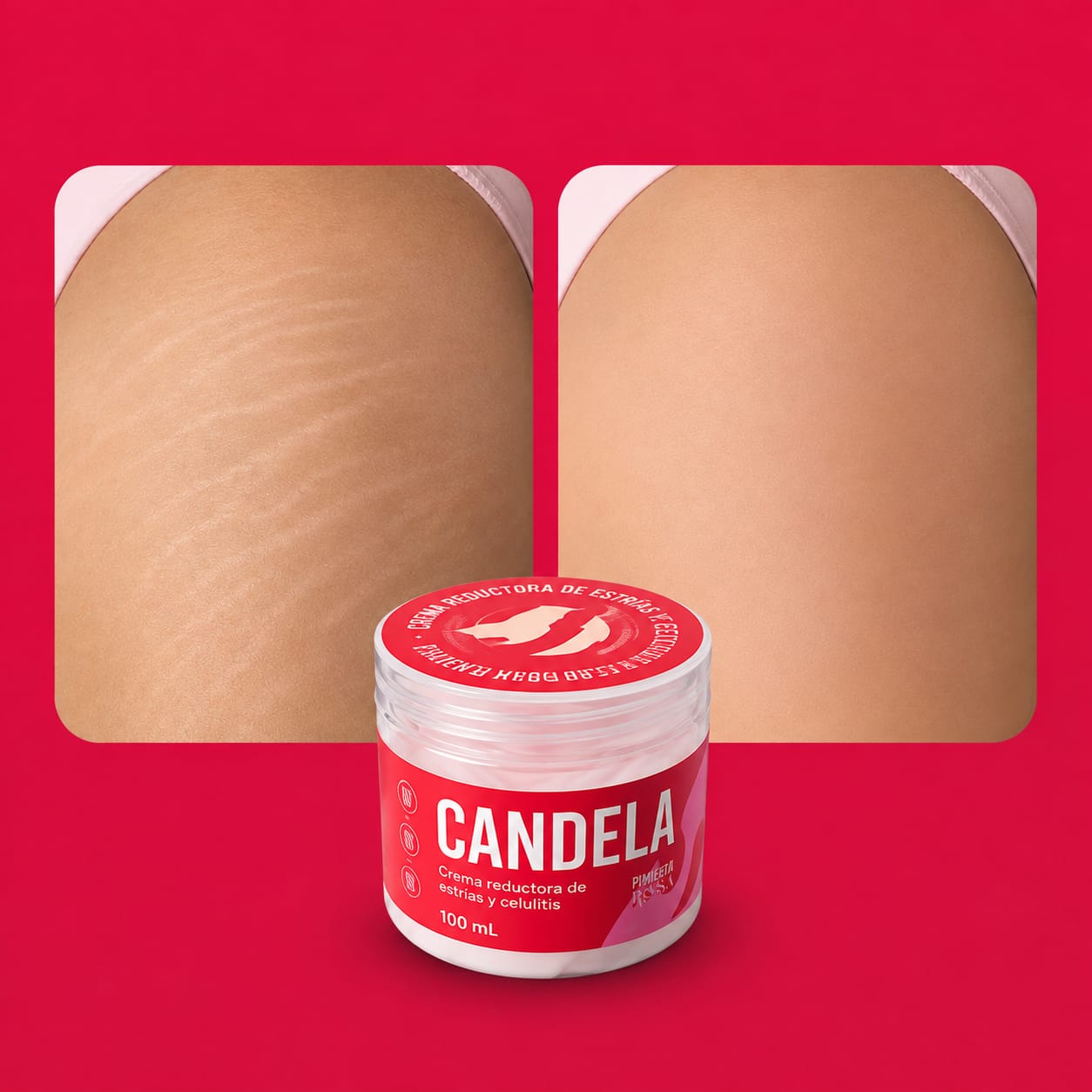 Antes y después: piel con estrías y piel tratada con Candela